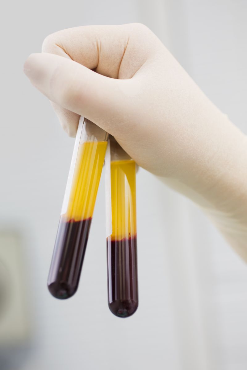 Lipoproteina a: jakie parametry krwi są jeszcze ważne?