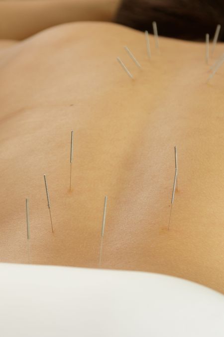 Bóle karku: akupunktura i technika Aleksandra zamiast medycyny konwencjonalnej